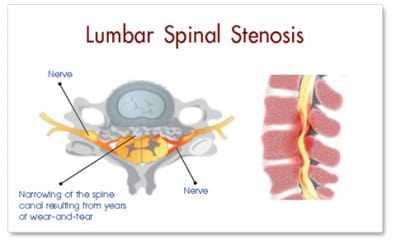 lumbar-spinal-stenosis