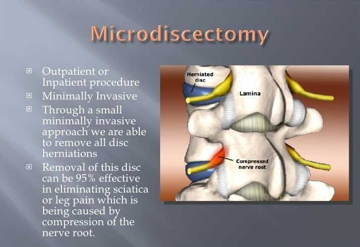 microdiscectomy1