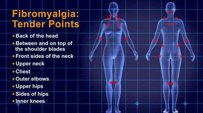fibromyalgia tender points