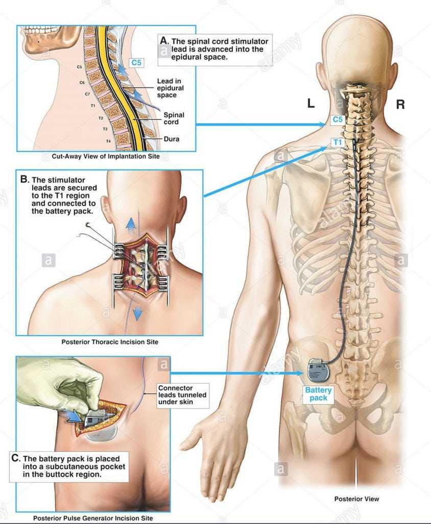 implantation of spinal cord stimulator and pulse generator