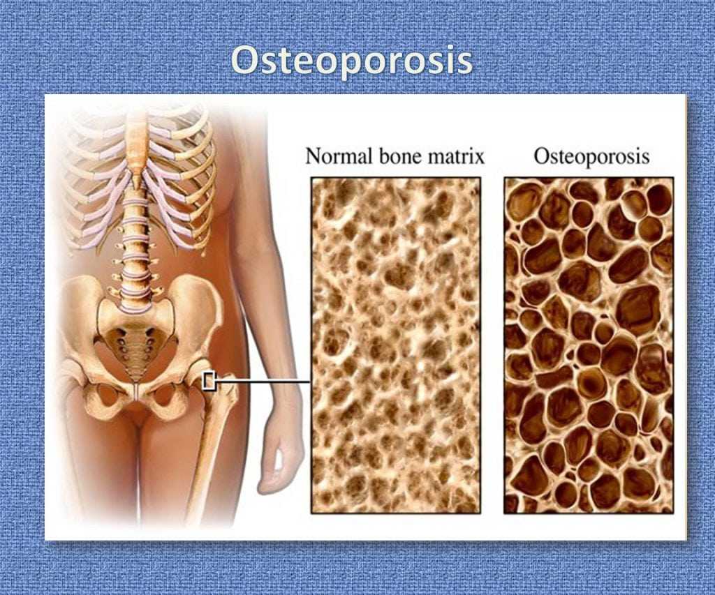 osteoporosis_