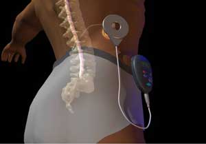spinal cord stimulation radio frequency