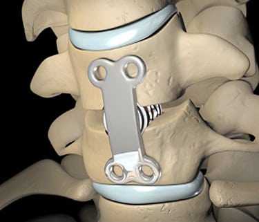 spinal-fusion