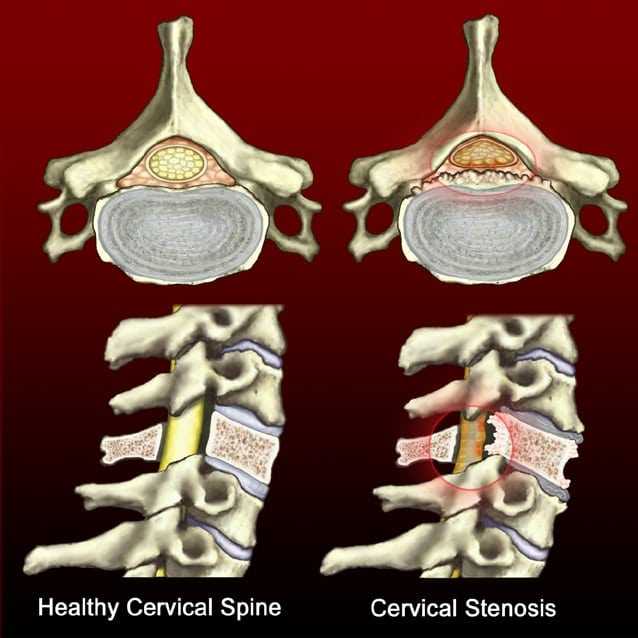 Cervical Spinal Stenosis