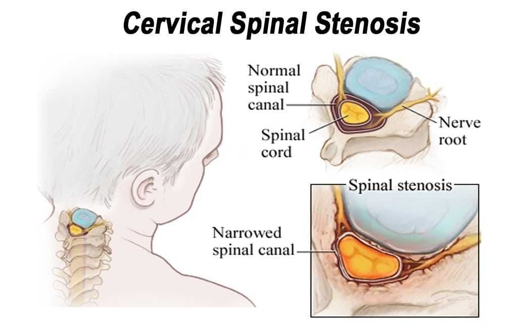 Cervical spinal stenosis