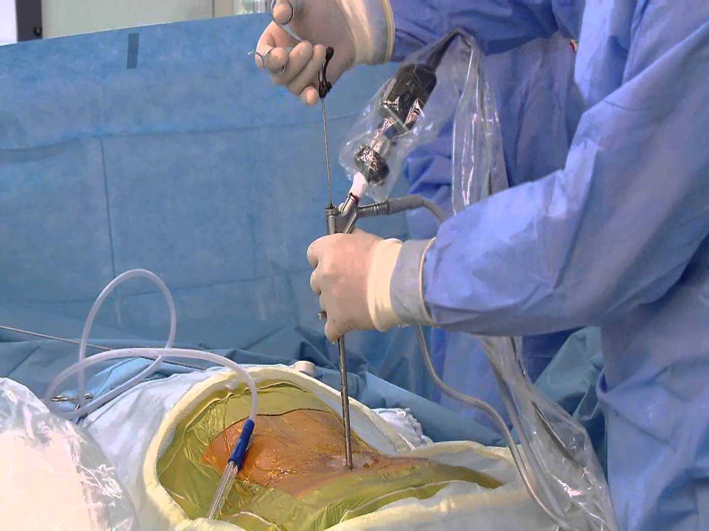 Endoscopic Discectomy Surgery