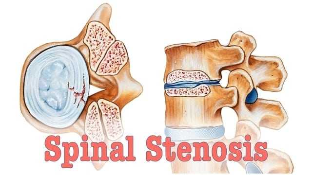 What is Spinal Stenosis ?
