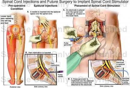 Spinal cord stimulation surgery