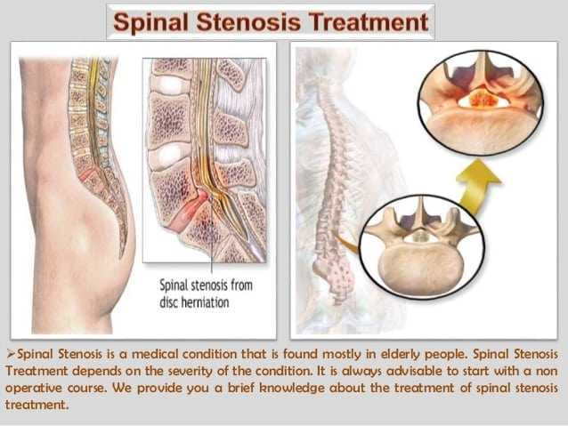spinal stenosis treatment