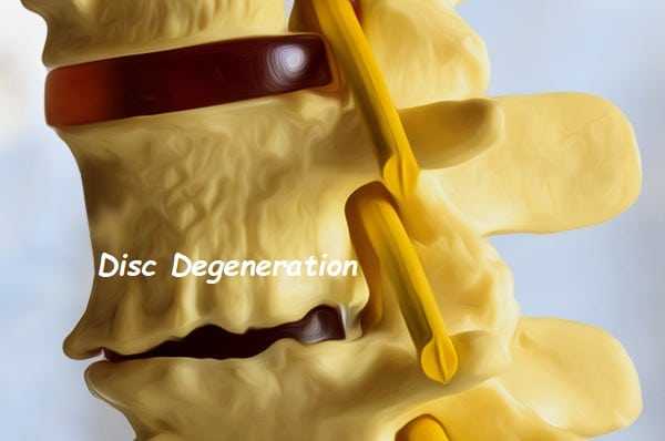 degenerative disc