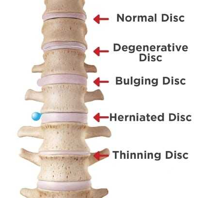 difference between bulged herniated disc