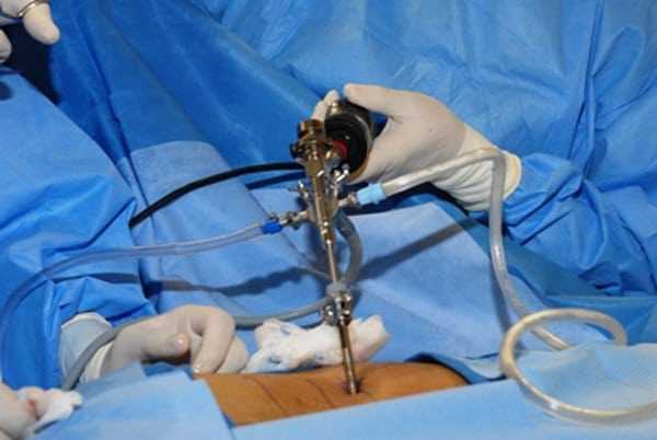 endoscopic surgery