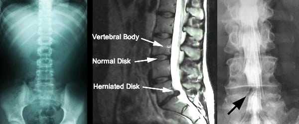 herniated_disc_x-ray