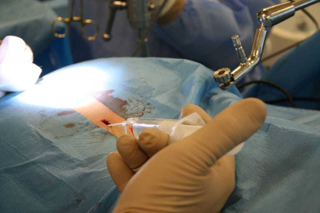 micro endoscopic spine surgery