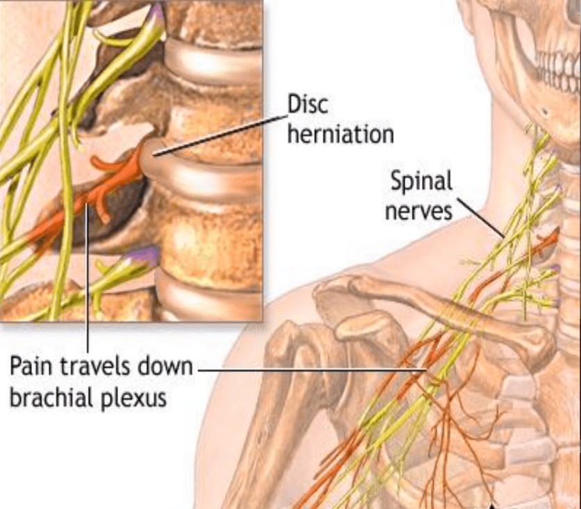 pinched nerve in neck