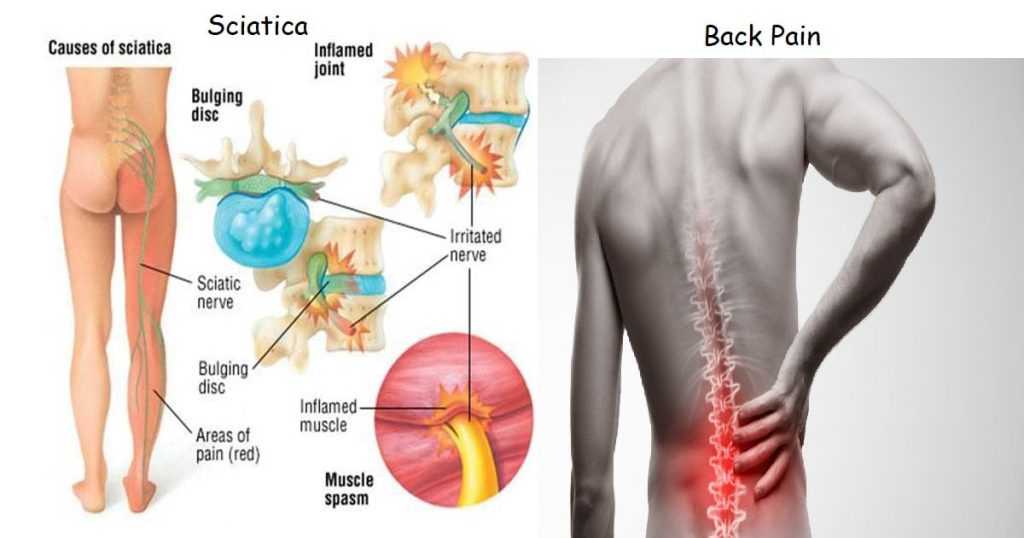 sciatica and back pain
