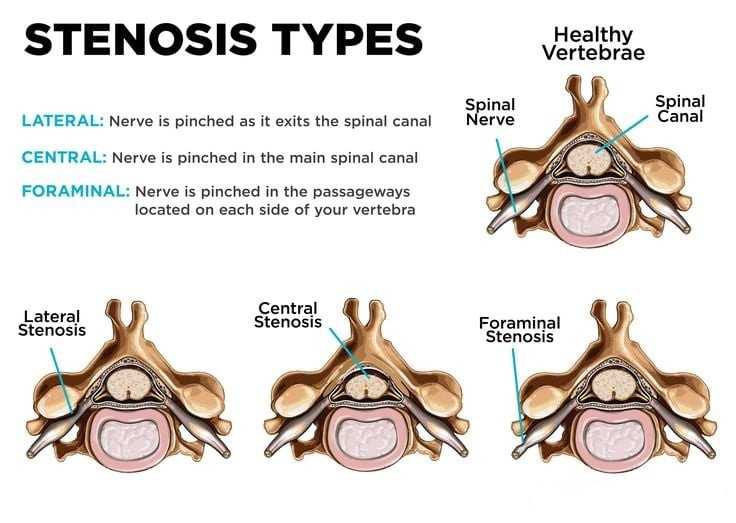 spinal stenosis types