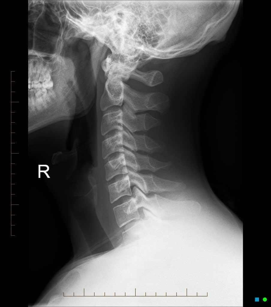 Cervical Spine X-Rays