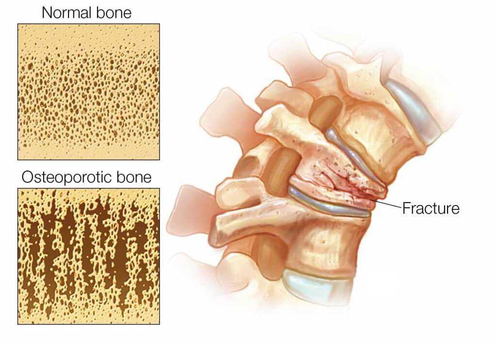 Osteoporotic Fracture