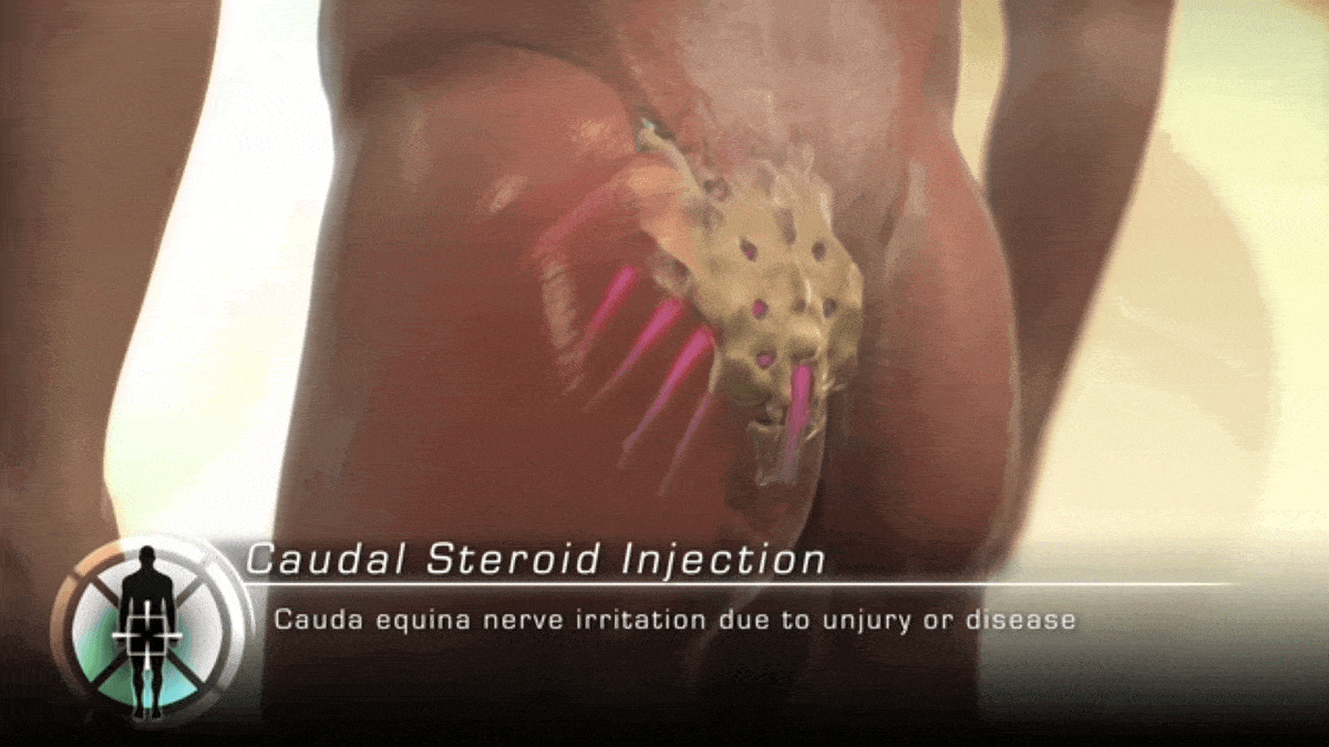 Sacral(Caudal) Epidural Injection