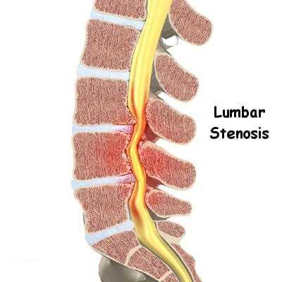 Spinal Stenosis Back Pain