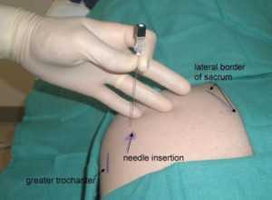 injection of piriformis syndrome