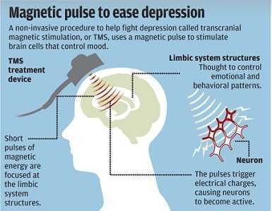 magnetic pulse to ease depression