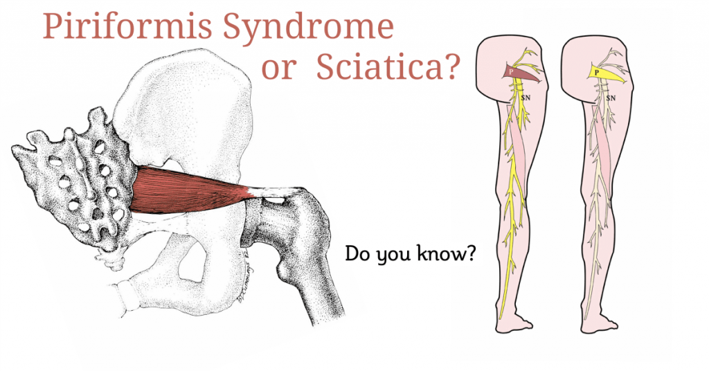 sciatica and piriformis syndrome