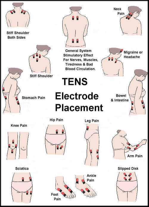 tens electrode placement