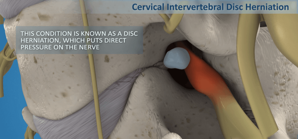 Cervical Herniated Disc