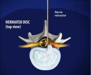 Lumbar Discectomy nerve retractor