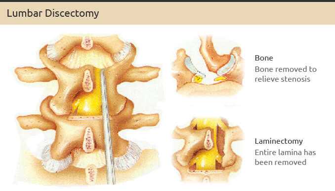 LumbarDiscectomy