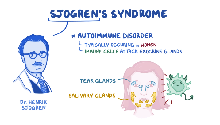 Sjogren’s Syndrome