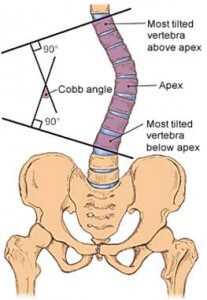 The Therapy Of Scoliosis