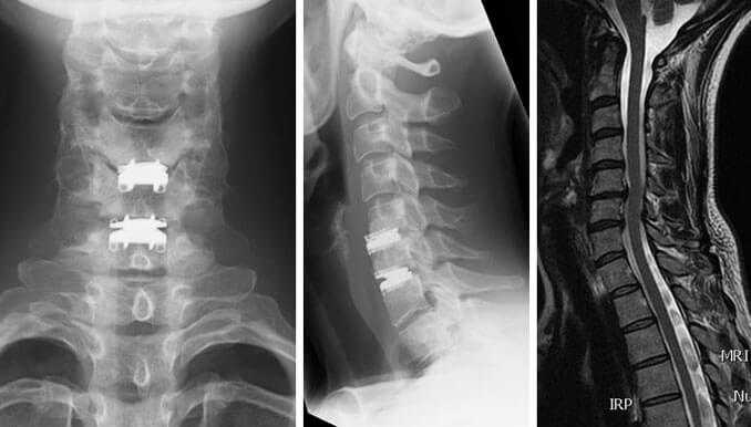 cervical disc replacement