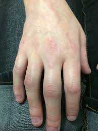 joint swelling hand
