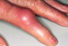 joint swelling