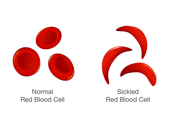 About Sickle Cell Disease