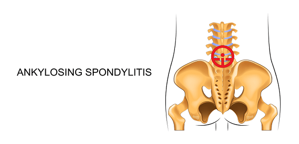 Ankylosing Spondylitis Osteoarthritis