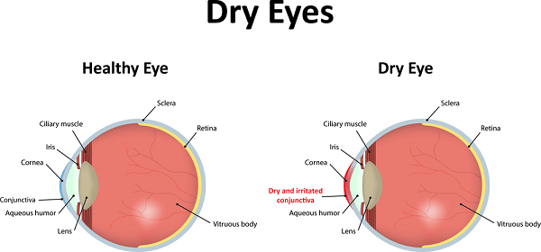 Eye Dryness