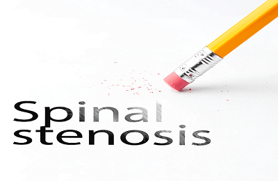 Spinal Stenosis Information 1