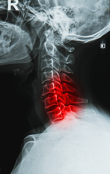 spinal stenosis mri