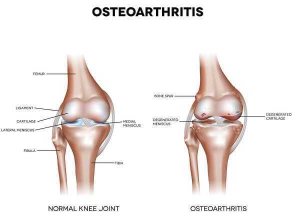 Knee Osteoarthritis and normal joint detailed anatomy