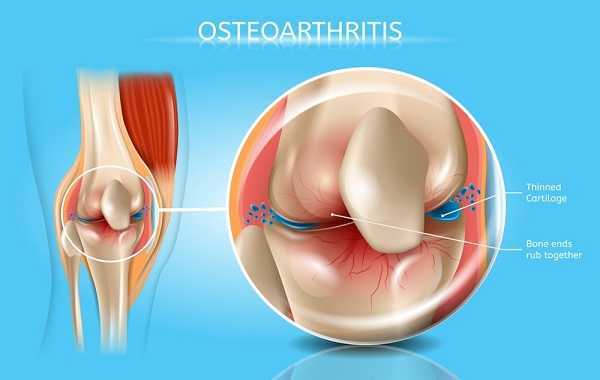 Osteoarthritis Vector Medical Poster with Magnification of Thinned Cartilage