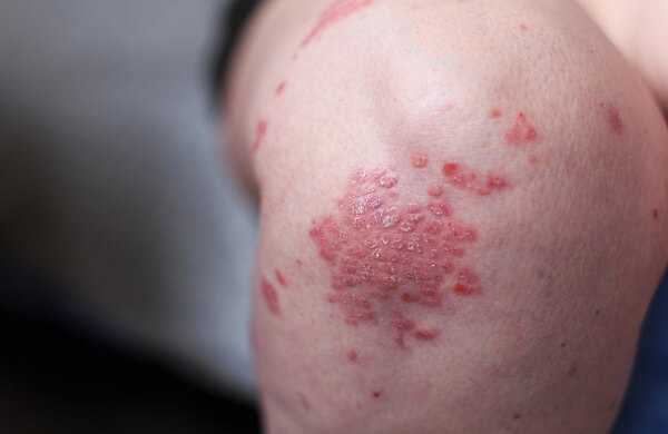 Psoriasis vulgaris is an autoimmune disease that affects the skin, detail photography for mainly medical magazines.
