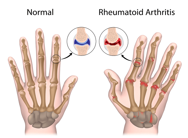 Rheumatoid arthritis of hand