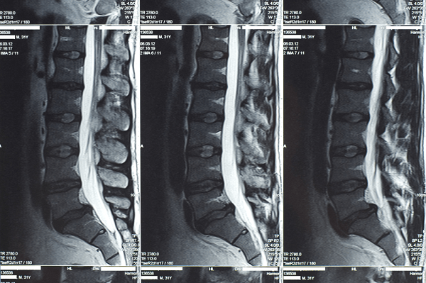herniated disc diagnosis with mri