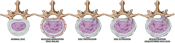 Types and stages of lumbar disc herniation
