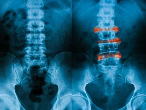 L-S spine X-ray image, AP view, comparison between normal and ankylosing spondylitis lumbar