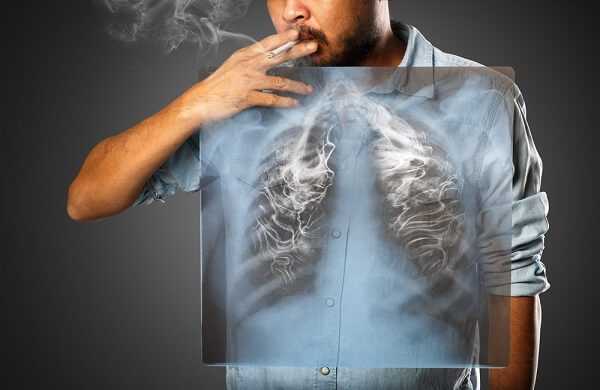Crohns Disease and Smoking
